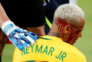 Il brutto infortunio di Neymar